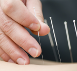 Acupuntura e a Covid-19