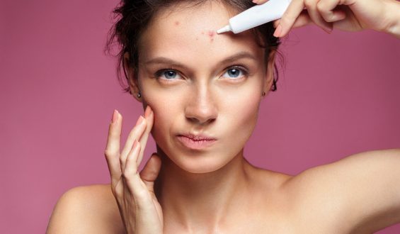 Como tratar espinhas; confira as melhores dicas