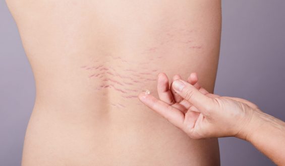 Apesar dos tratamentos, prevenção é a melhor forma de não ter estrias