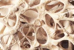 10 mitos e verdades sobre a osteoporose