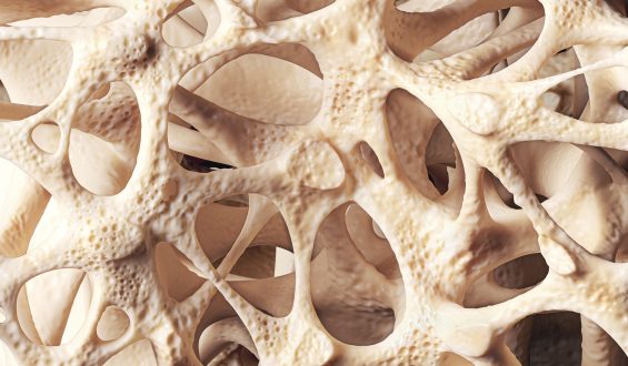 10 mitos e verdades sobre a osteoporose
