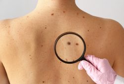 “ABCDE” na vida adulta: Autoexame é ferramenta importante na identificação de Câncer de Pele