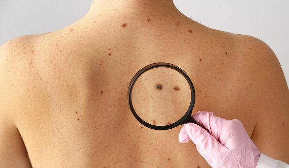 “ABCDE” na vida adulta: Autoexame é ferramenta importante na identificação de Câncer de Pele