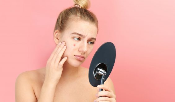 Acne na mulher adulta