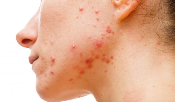Por que temos acne?