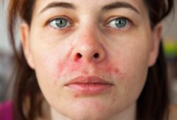 Dermatite perioral