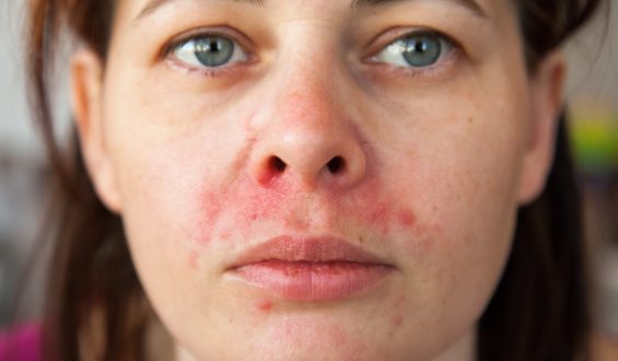 Dermatite perioral