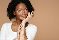 Vitiligo: o que é, causas, sintomas e tratamentos