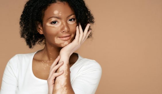 Vitiligo: o que é, causas, sintomas e tratamentos