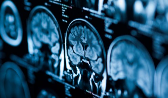 O que a terapia de reposição hormonal tem a ver com o Alzheimer?