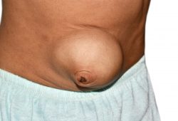 Hérnias abdominais: conheça os sintomas e fatores de risco da doença