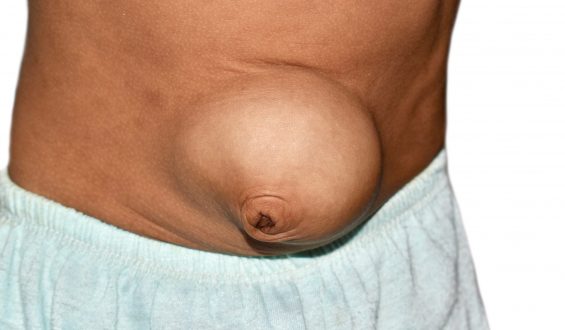 Hérnias abdominais: conheça os sintomas e fatores de risco da doença