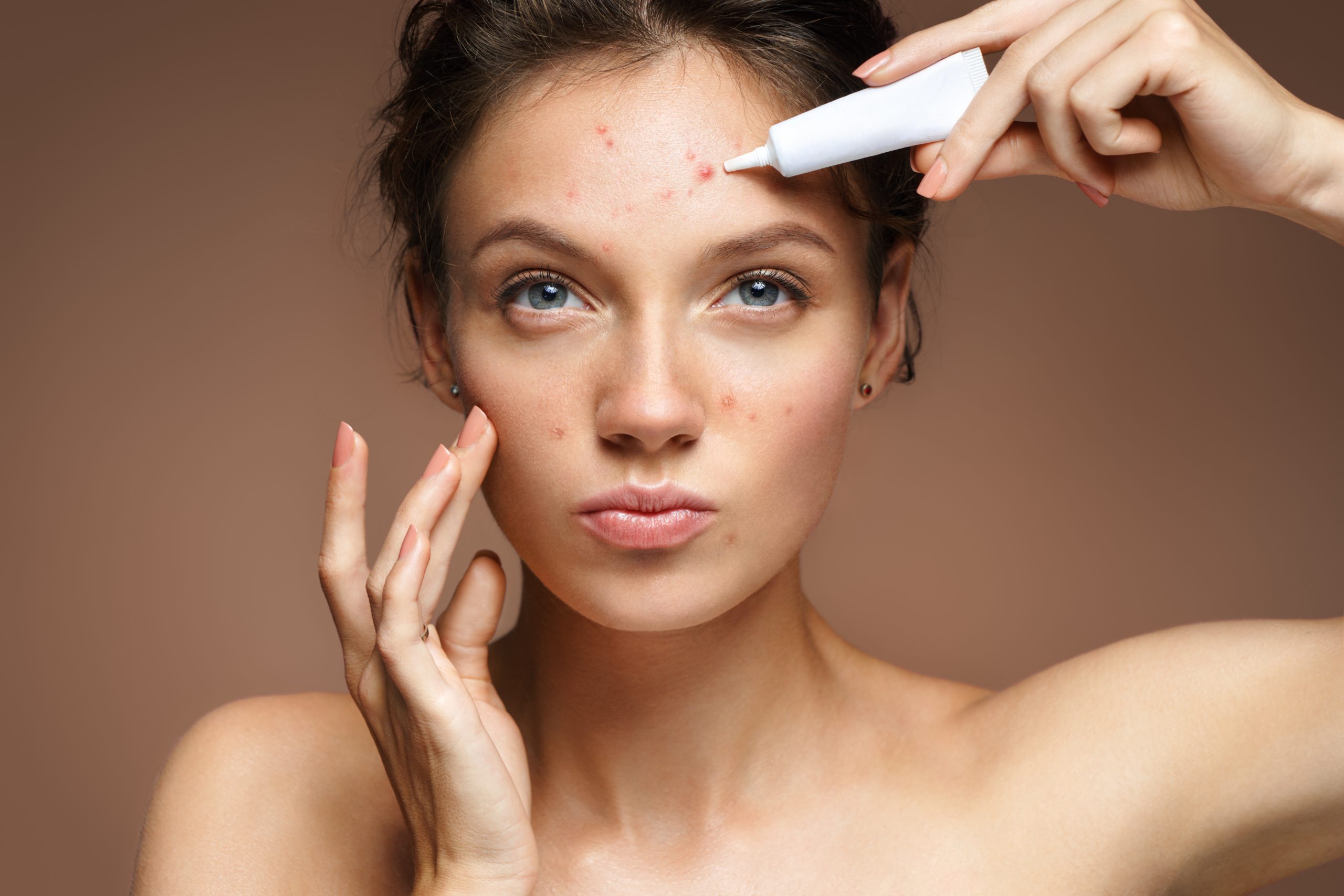 Por que o excesso de maquiagem pode causar acne?