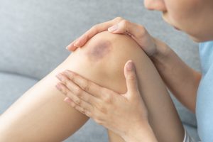 Reparem que em algumas vezes depois de tirar sangue, o local onde a agulha foi colocada, muitas vezes pode ficar com uma manchinha roxa, ou seja, um pequeno hematoma. Querem saber o que é um hematoma e por que ele fica nessa cor? Vamos explicar! 