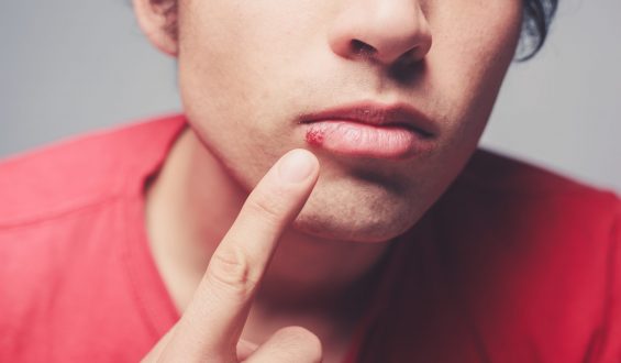 Herpes: Conheça os tipos da doença, sintomas e os tratamentos