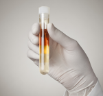 O que a cor da sua urina diz sobre sua saúde?