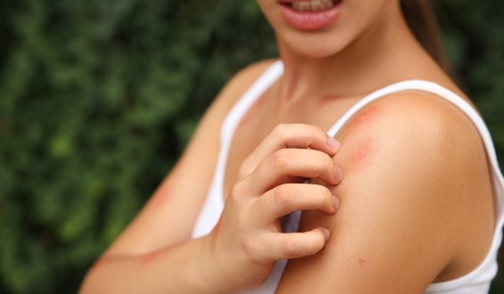 Por que os mosquitos gostam tanto de mim?