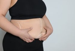 10 verdades sobre a bariátrica