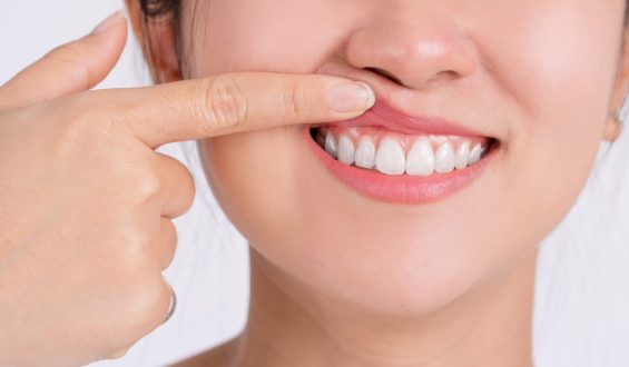 Plástica na gengiva: muito além da estética, procedimento traz um sorriso saudável