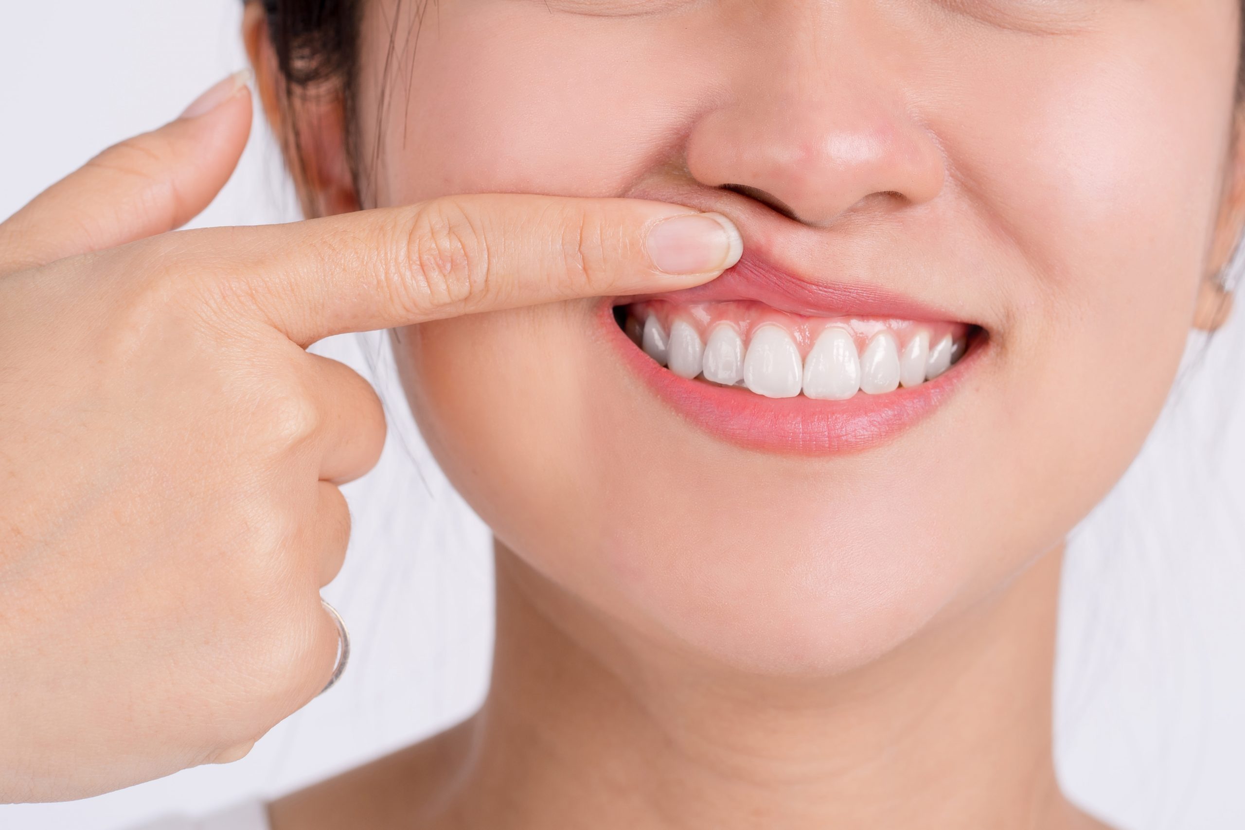 Plástica na gengiva: muito além da estética, procedimento traz um sorriso saudável