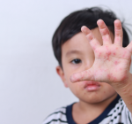 Mão-pé-boca: doença viral que acomete crianças de até 5 anos