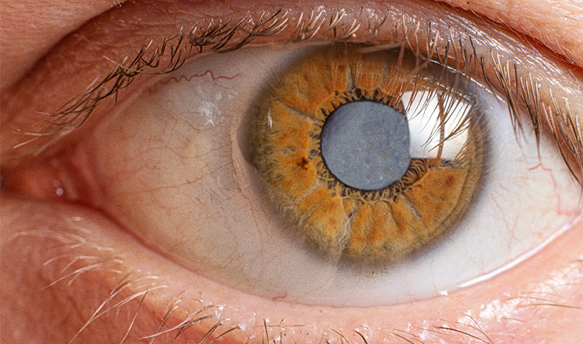 Catarata: ainda cercada de mitos, condição afeta 25% dos brasileiros com mais de 50 anos