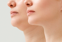 Lipo de papada ou tratamento de flacidez?