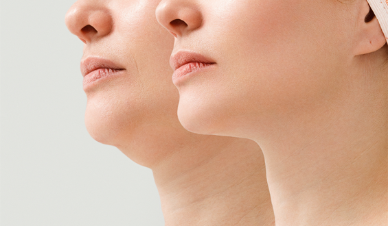Lipo de papada ou tratamento de flacidez?