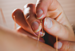 A acupuntura substitui os medicamentos tracionais?