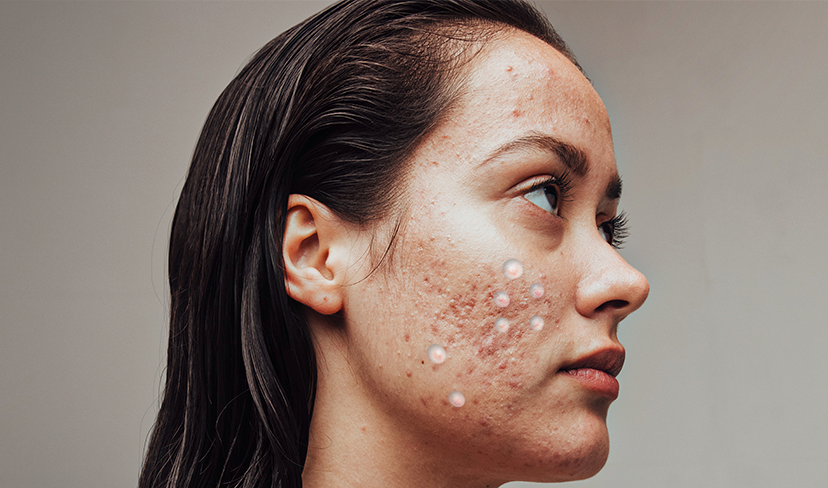 Adesivos para espinhas: eles realmente funcionam?