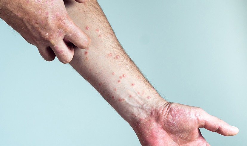 Dia Mundial da Psoríase: conheça a doença, sintomas e como se tratar