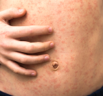 São Paulo emite alerta para vacinação contra sarampo; entenda