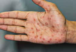 Sífilis congênita: o que é, como prevenir e tratar
