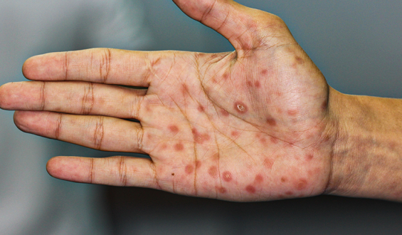 Sífilis congênita: o que é, como prevenir e tratar