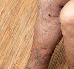 Como prevenir e tratar a trombose em todas as idades