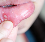 Afta: saiba como evitar e as causas