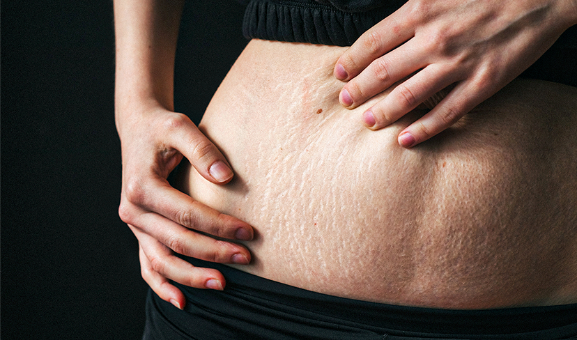 Estrias: como tratar e se prevenir