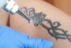 Remoção de tatuagens: métodos e resultados