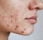 Acne solar: como cuidar da pele acneica no verão