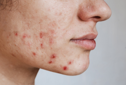 Acne solar: como cuidar da pele acneica no verão