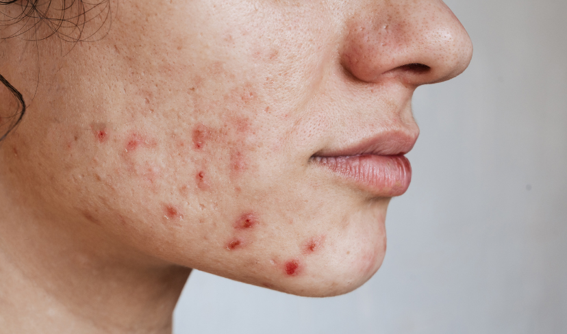 Acne solar: como cuidar da pele acneica no verão