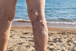 Saúde das pernas no verão: como prevenir e se livrar das varizes