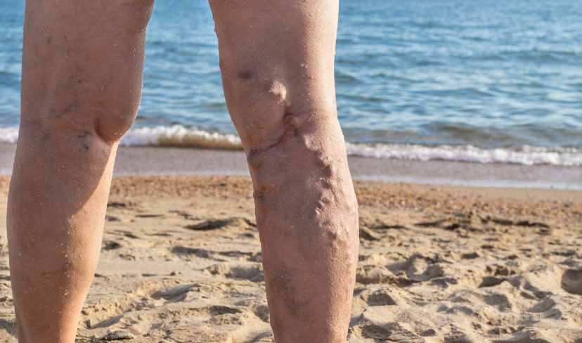 Saúde das pernas no verão: como prevenir e se livrar das varizes