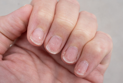 Por que as unhas descamam? Possíveis causas, diagnóstico e tratamento