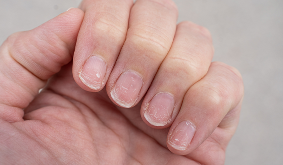 Por que as unhas descamam? Possíveis causas, diagnóstico e tratamento