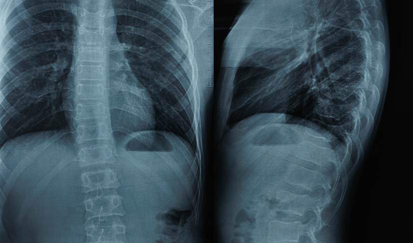 CONHEÇA OS 3 TIPOS DE ESCOLIOSE E SEUS RISCOS