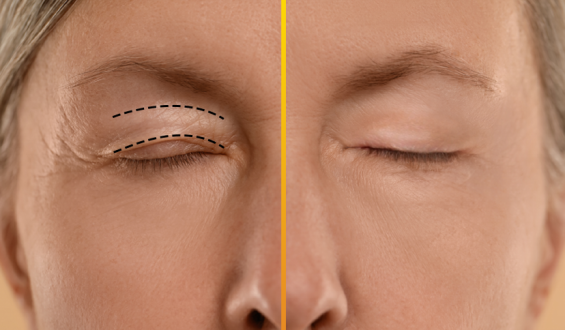 Blefaroplastia: Tradicional ou a Laser?