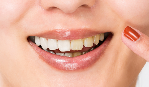 Envelhecimento dos dentes: prevenção e tratamento