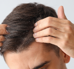 Doenças de cabelo mais comuns no verão