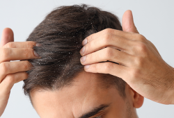 Doenças de cabelo mais comuns no verão